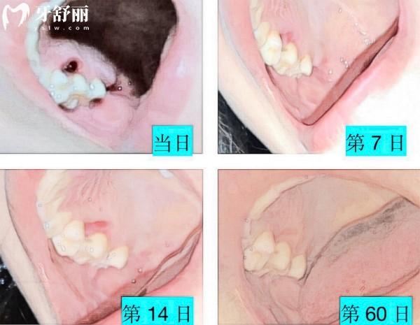 拔牙窟窿七天愈合圖