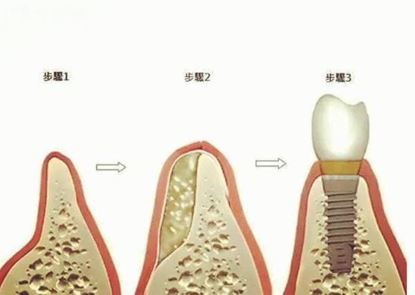 秦皇島種牙價(jià)格表