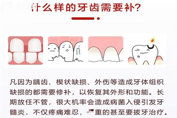 補(bǔ)牙