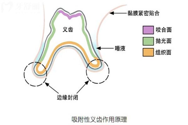 吸附性義齒