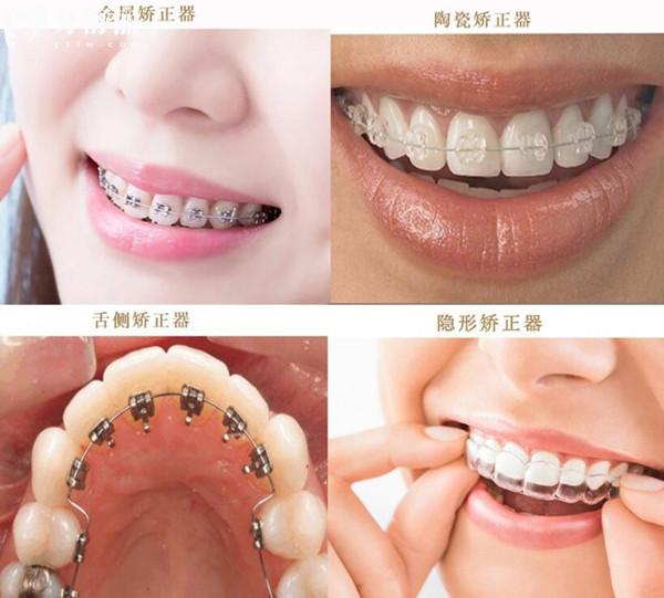 貴陽柏德口腔醫(yī)院收費如何?不貴,現(xiàn)在種植牙2980+正畸5800+