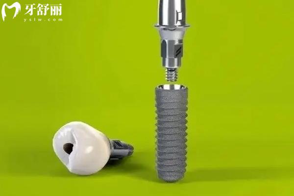 宜春種植牙集采價格