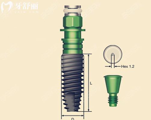 美國儒伽zuga種植體
