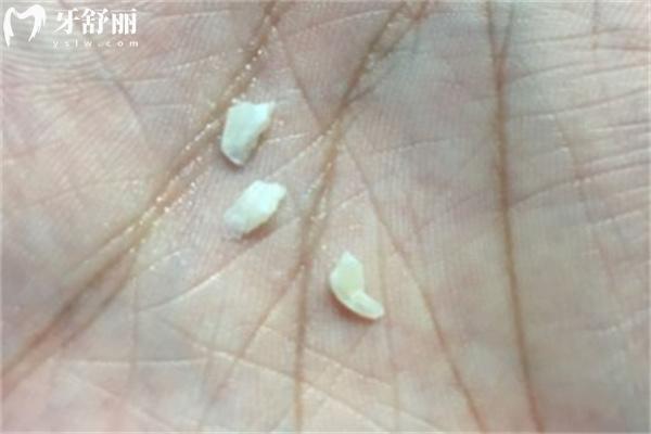 牙齒內(nèi)側(cè)掉了一小塊