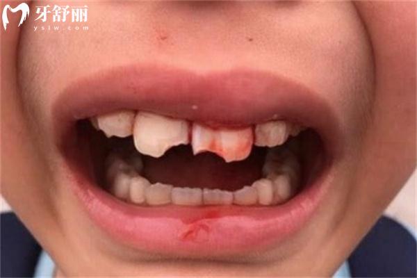 牙齒內(nèi)側(cè)掉了一小塊