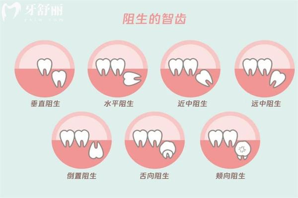 智齒把牙齒擠歪了矯正多少錢