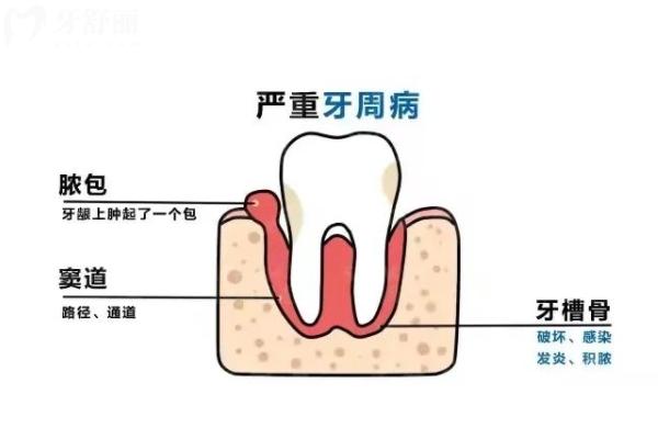 牙周炎一輩子都治不好嗎？