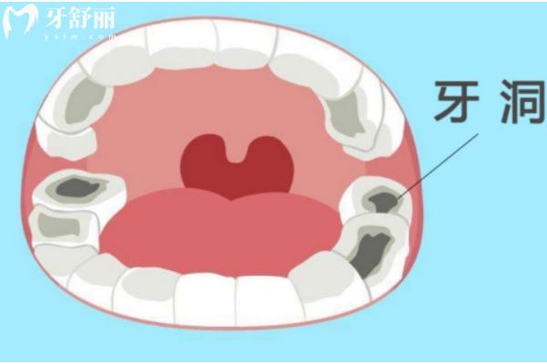 牙齒爛到什么程度就不能補(bǔ)了