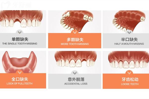 湖州牙科醫(yī)院一顆種植牙多少錢