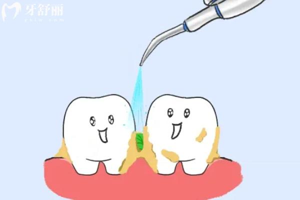 30歲做了滿口烤瓷牙能用一輩子嗎