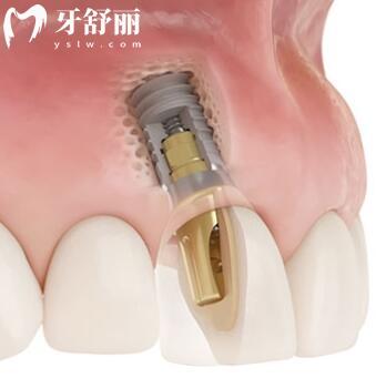 哈爾濱醫(yī)大**種植牙多少錢?一顆2880+半口1.6萬(wàn)全口費(fèi)用明細(xì)公開