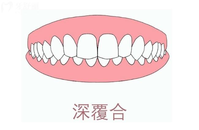 深覆合不矯正將來(lái)會(huì)咋樣