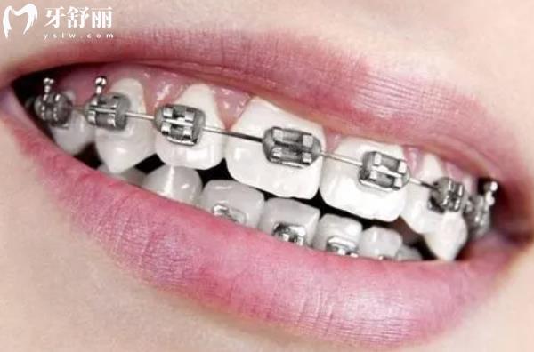 牙齒深覆合不矯正會(huì)怎么樣