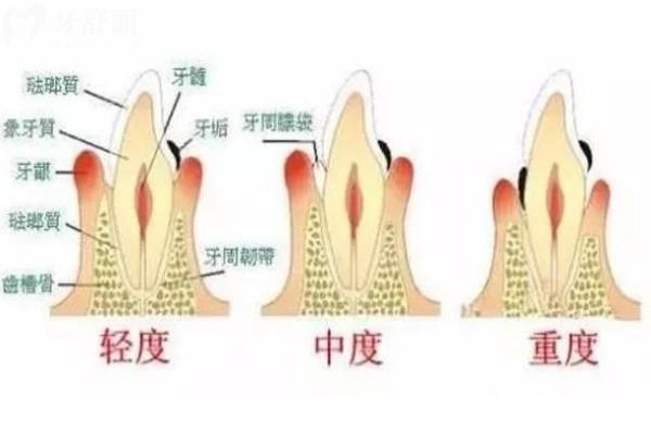 牙齦萎縮不同程度對(duì)比