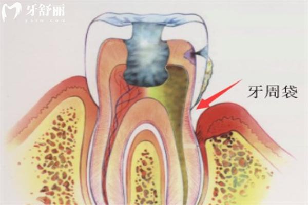 侵襲性牙周炎能種牙嗎