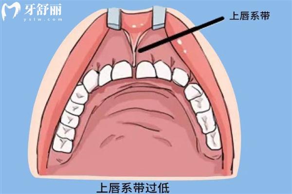 笑露牙齦與唇系帶有關(guān)系嗎？