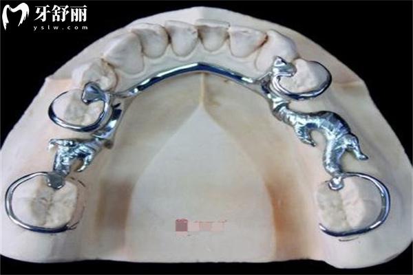 太原全口假牙價(jià)格表已出:活動(dòng)牙/吸附牙/固定種植牙種類齊全附醫(yī)院名單