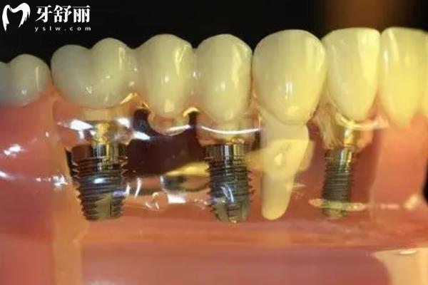 種植牙種什么材質(zhì)的好？