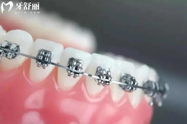 蘭州牙齒矯正大概要花費多少錢