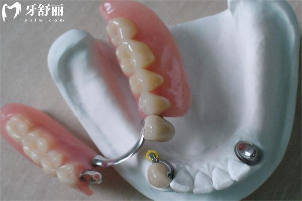 老年人全口假牙多少價(jià)格