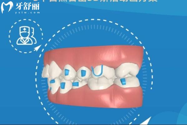 烏魯木齊矯正牙齒大概多少錢