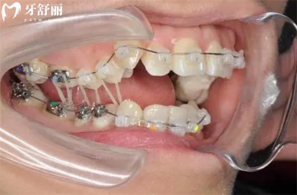 北京亦莊矯正牙齒價格表