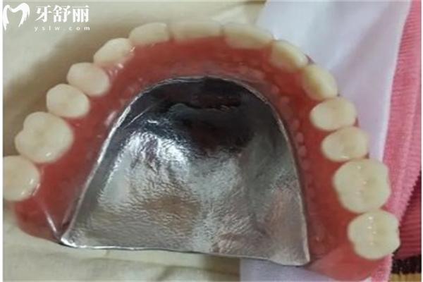 吉林全口假牙價格表