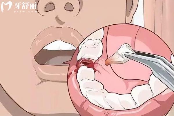拔牙后吃冰激凌不會(huì)污染傷口嗎？
