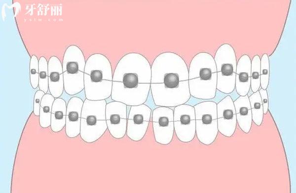 西寧牙齒矯正多少錢