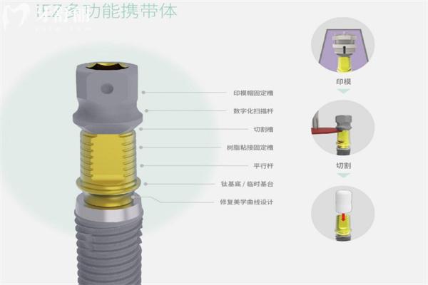iEZ種植體