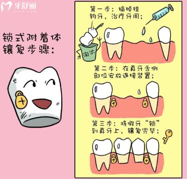 無掛鉤假牙