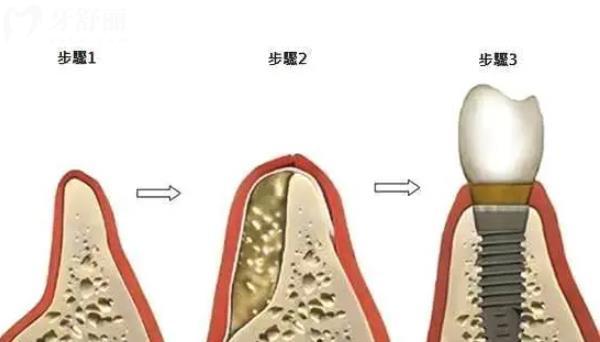 牙槽骨再生手術