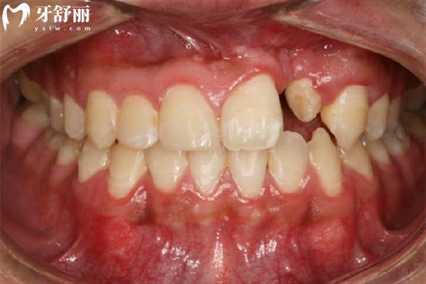 做過腭裂手術還能做牙齒矯正嗎