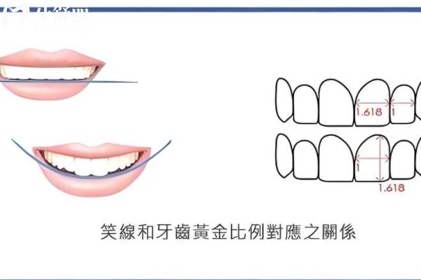 ??VITA琥珀瓷貼面