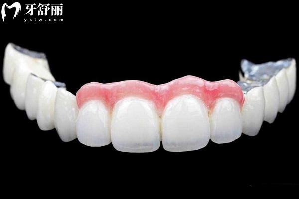 愛爾創(chuàng)全瓷牙冠質保幾年