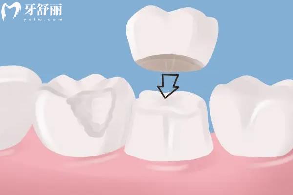 殺神經(jīng)和根管治療是一回事嗎？