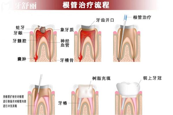 根管治療為啥前牙和后牙的價(jià)格不一樣？