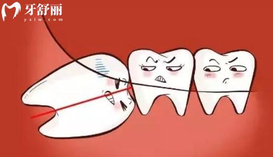 簡單智齒和復(fù)雜智齒如何判斷？
