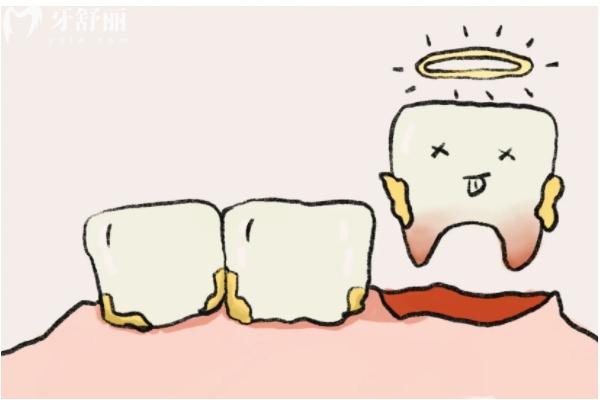 先洗牙還是先拔牙補(bǔ)牙？
