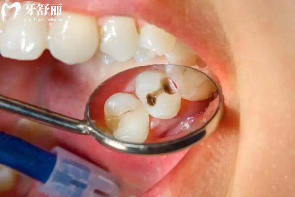 小孩子補了牙齒影響以后換牙齒嗎