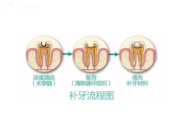 十歲孩子補(bǔ)牙，長(zhǎng)大后還需要補(bǔ)嗎