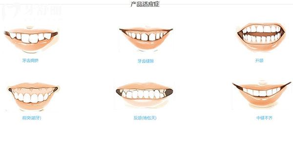 愛美適隱形牙套適應癥