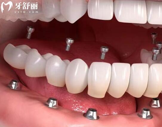 臨海德瓦口腔醫(yī)院收費(fèi)實(shí)惠,愛爾創(chuàng)全瓷牙899+拔智齒280+種植牙2580+