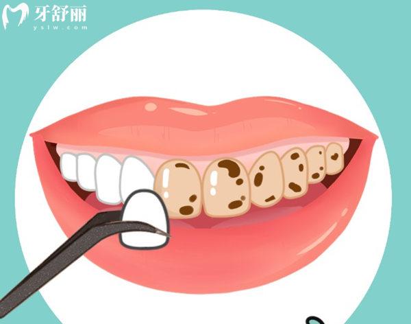 2025北京牙齒貼面的價格是多少