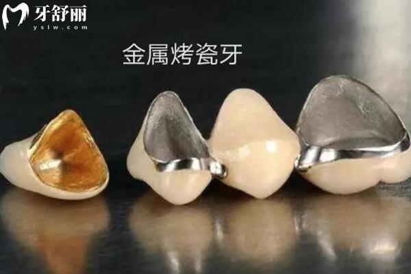上海鑲牙大概要多少錢?從一顆到滿口假牙價(jià)格全盤點(diǎn),低價(jià)至750+