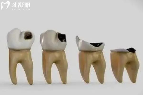 2025西安拔一顆牙多少錢？