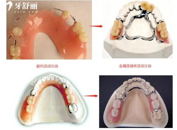 安裝活動(dòng)假牙單顆/半口/全口價(jià)格表