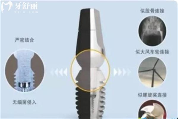 2025杭州種植牙價格表新