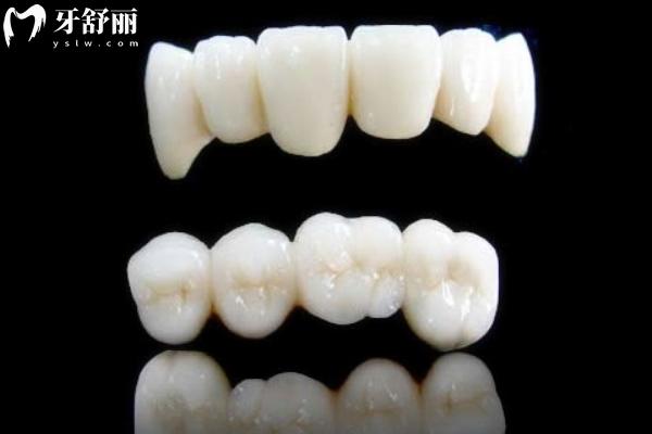 上海全瓷牙冠多少錢一顆