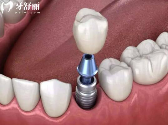 延吉種植牙多少錢2025年價(jià)格表:一顆2680-9500不等
